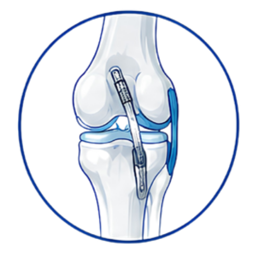 ACL Reconstruction (Copy)