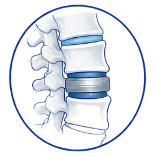 Cervical Disc Replacement (Copy)