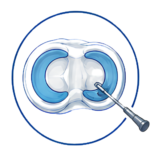 Knee Meniscus Surgery (Copy)