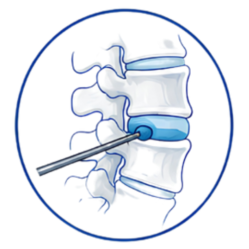 Microdiscectomy (Copy)