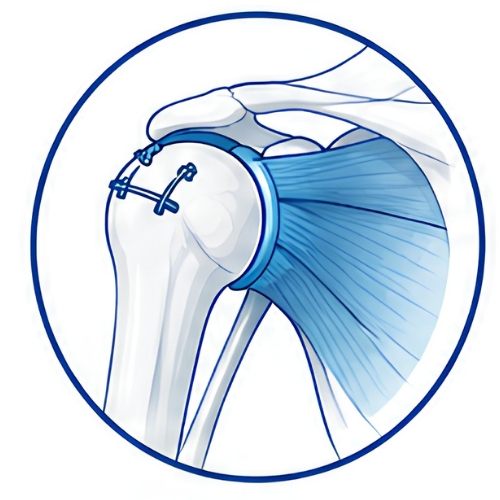 Rotator Cuff Repair (Copy)