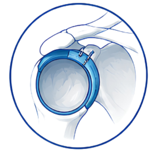 Shoulder Labrum Repair (Copy)