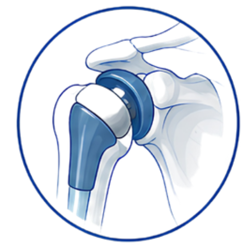 Shoulder Replacement Surgery (Copy)
