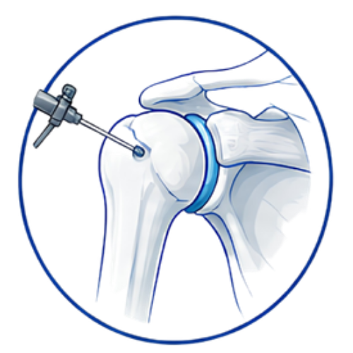 Shoulder Surgery (Copy)