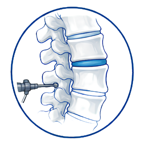 Spine Surgery (Copy)