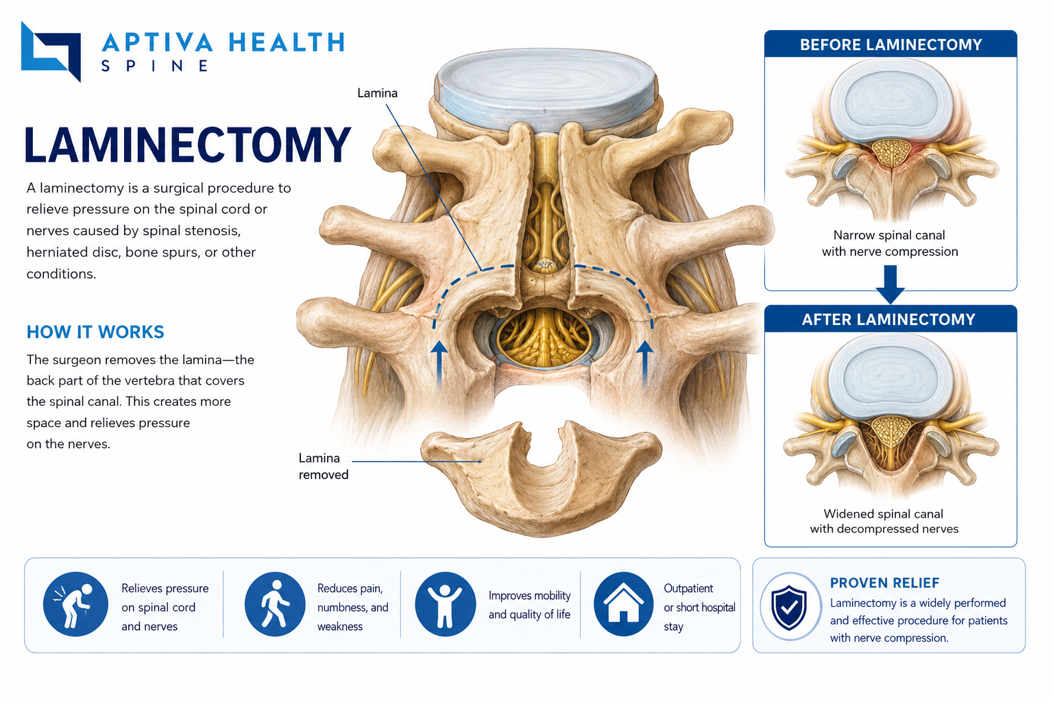 Lumbar laminectomy decompression surgery in Louisville, KY at Aptiva Health