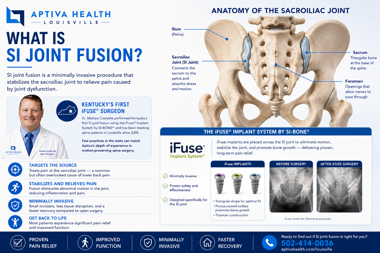 What is SI Joint Fusion