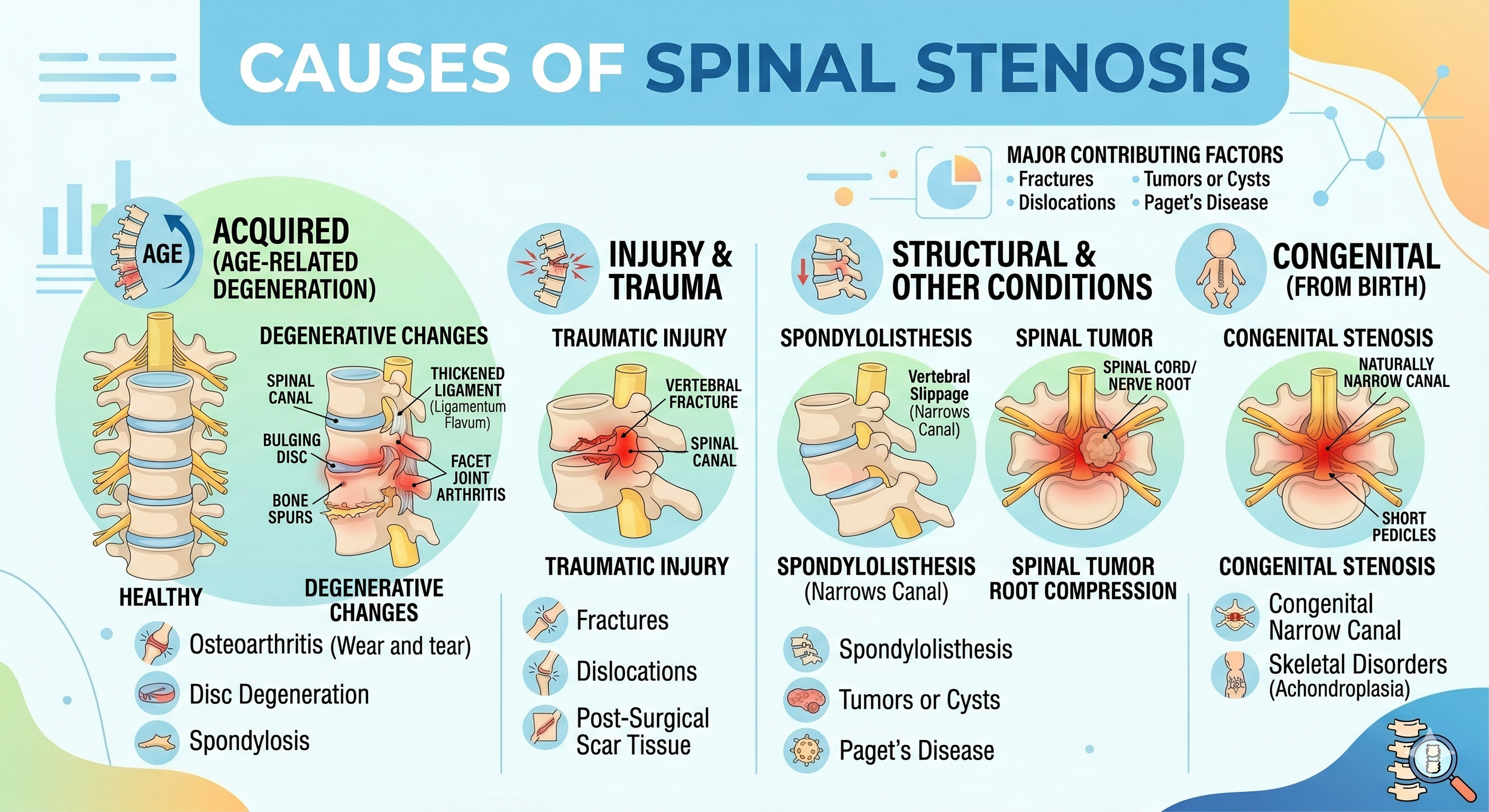 What are the common causes of spinal stenosis?