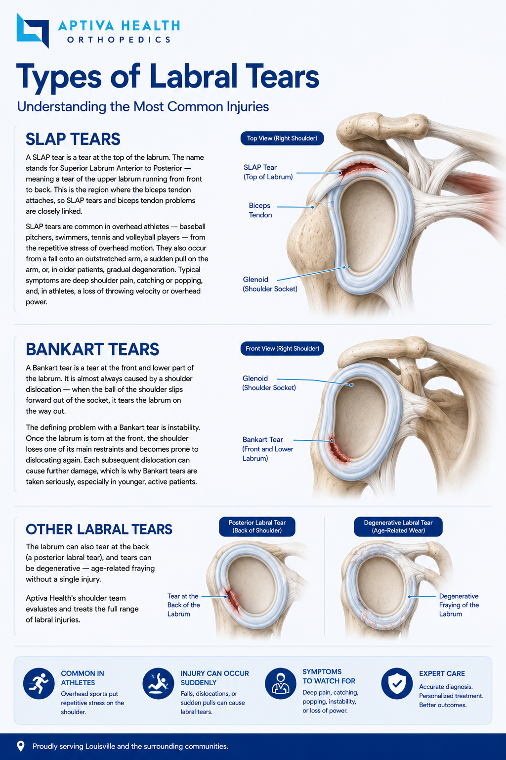 SLAP tear vs. Bankart tear — labral tear locations