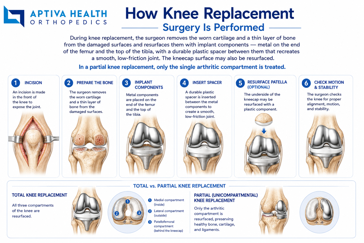 How knee replacement surgery is performed at Aptiva Health
