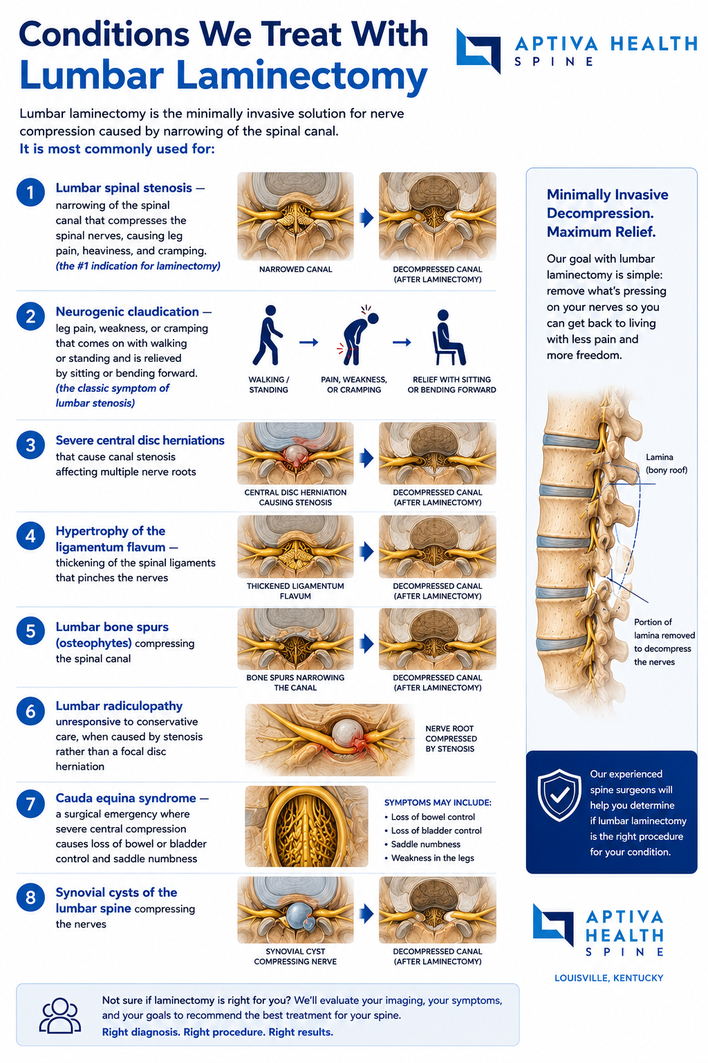 Lumbar conditions treated with laminectomy at Aptiva Health Louisville