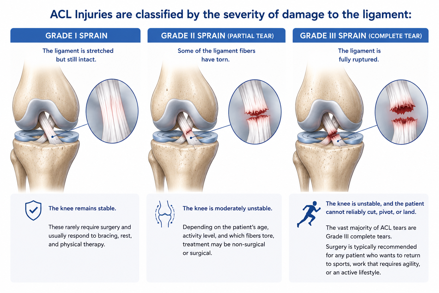 Types of ACL Tears of the Knee