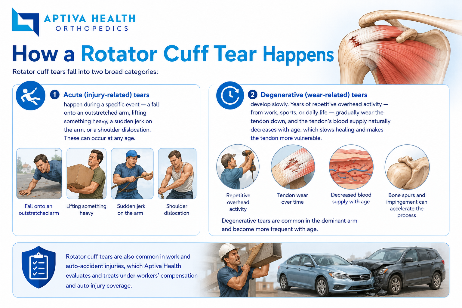 How a rotator cuff tear happens — injury and age-related wear