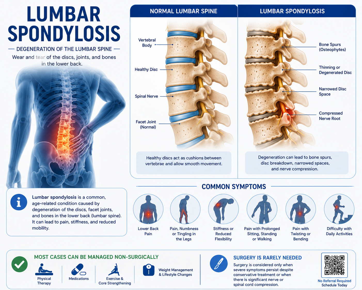 Lumbar Spondylosis