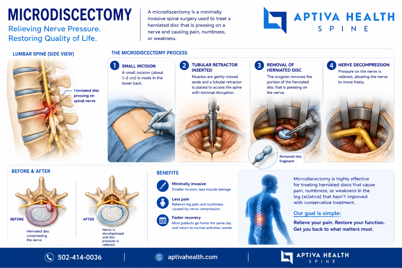 Minimally invasive microdiscectomy procedure at Aptiva Health Louisville