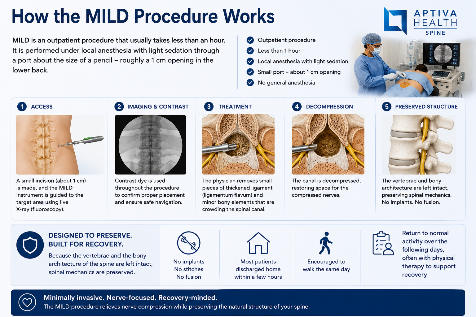 How the Mild Procedure Works