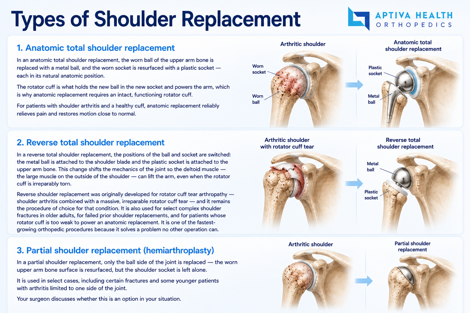 Anatomic, reverse, and partial shoulder replacement comparison