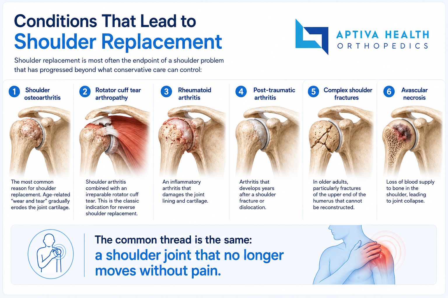 Shoulder arthritis and conditions that lead to shoulder replacement
