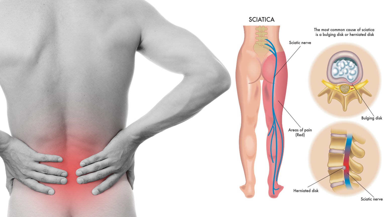 Sciatica  Aptiva Health