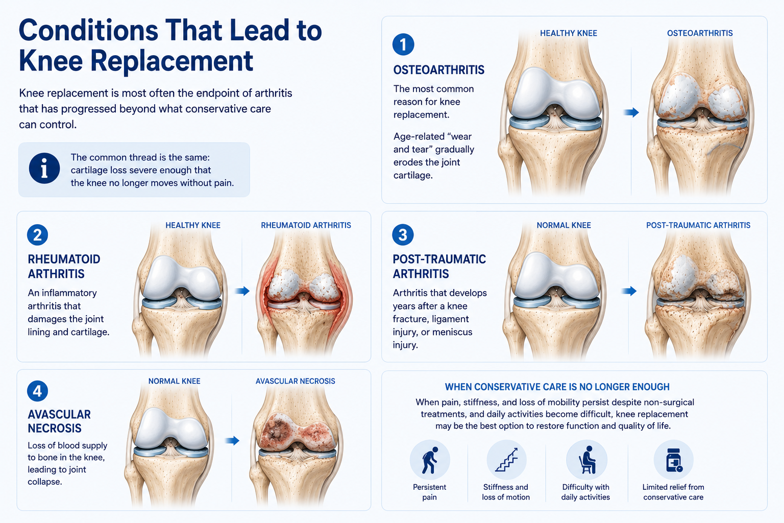 Knee arthritis and conditions that lead to knee replacement
