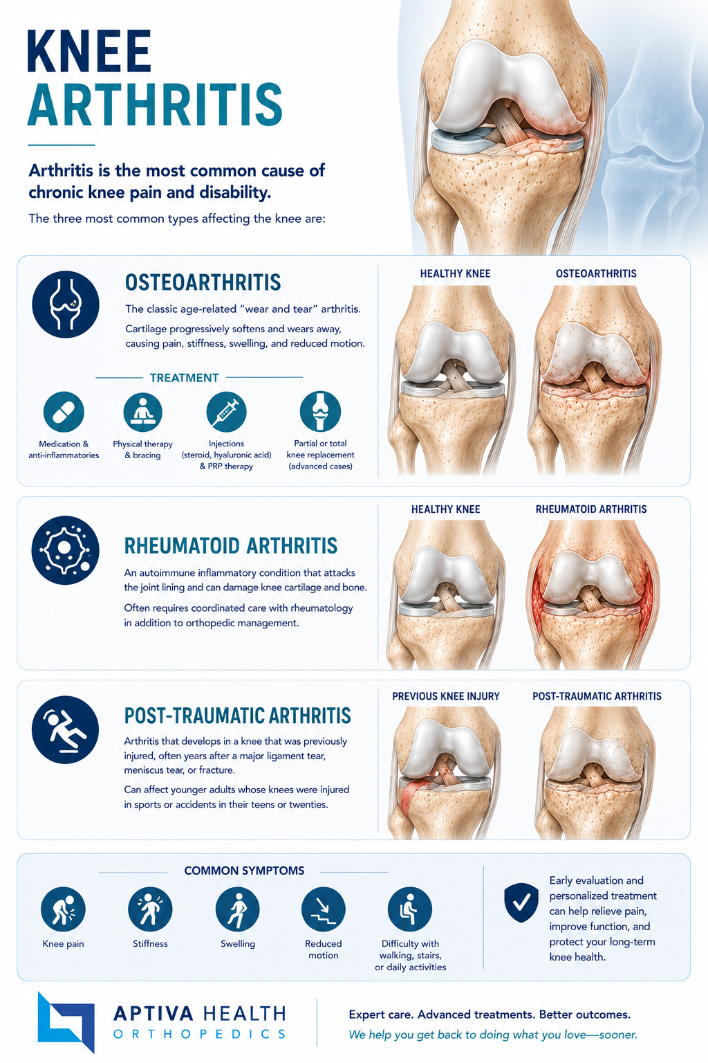 Knee Arthritis Treated at Aptiva Health