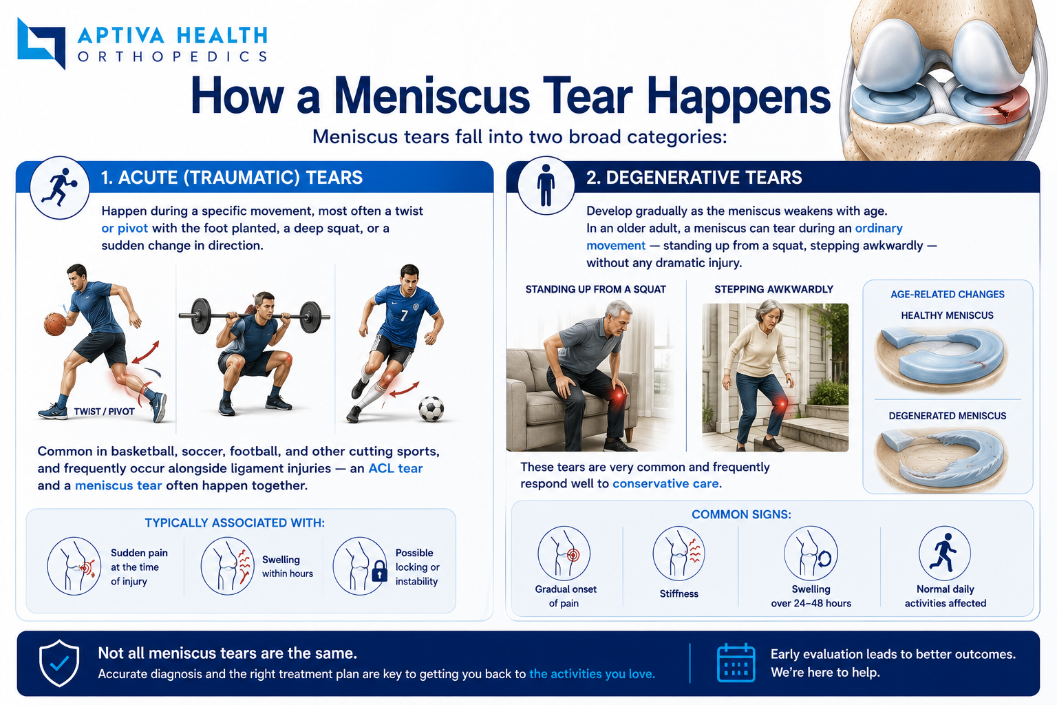 How a meniscus tear happens — twisting and pivoting injuries