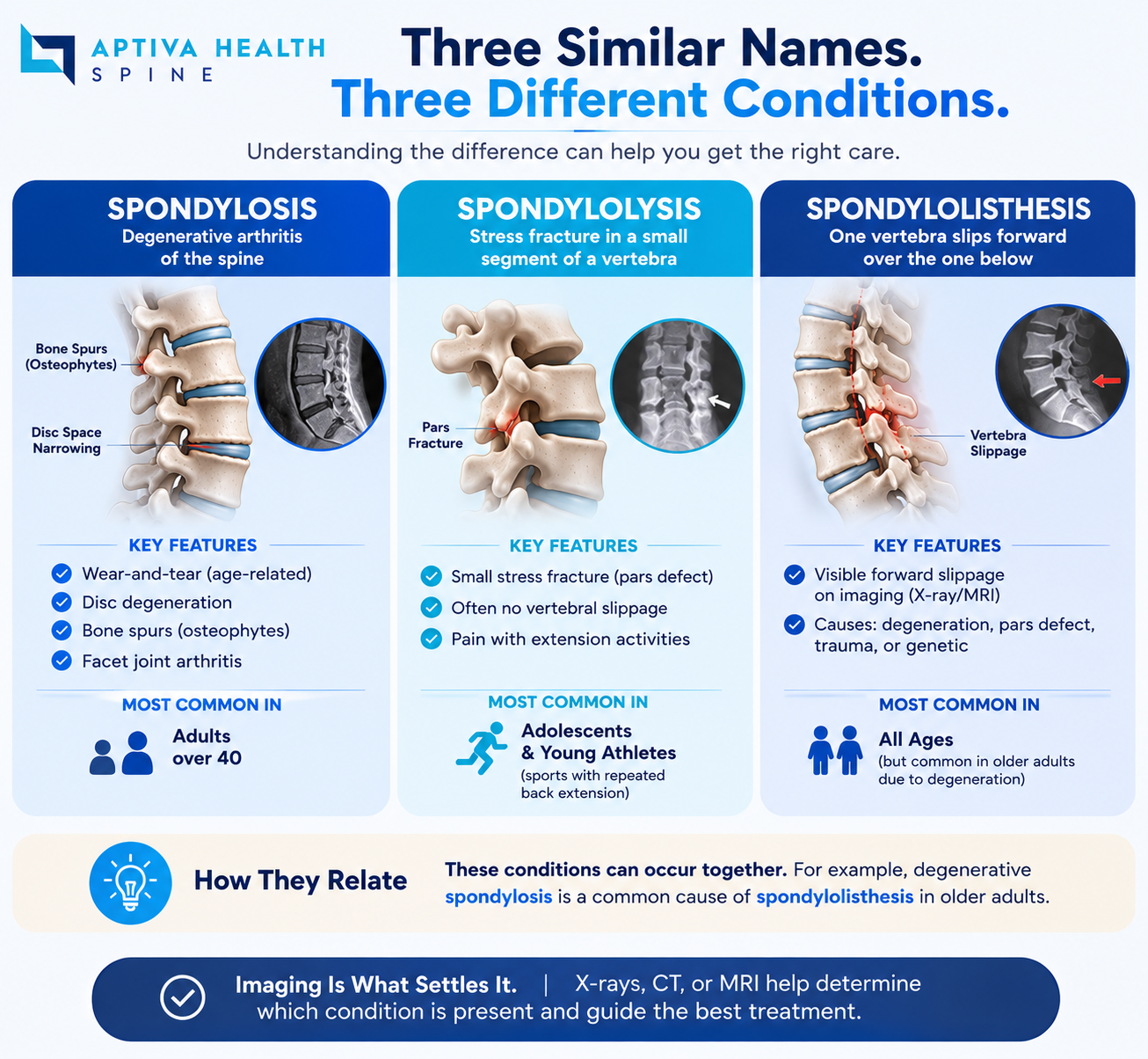 Learn About Spondylosis