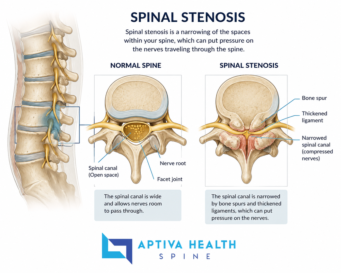 Spinal Stenosis Treatment at Aptiva Health