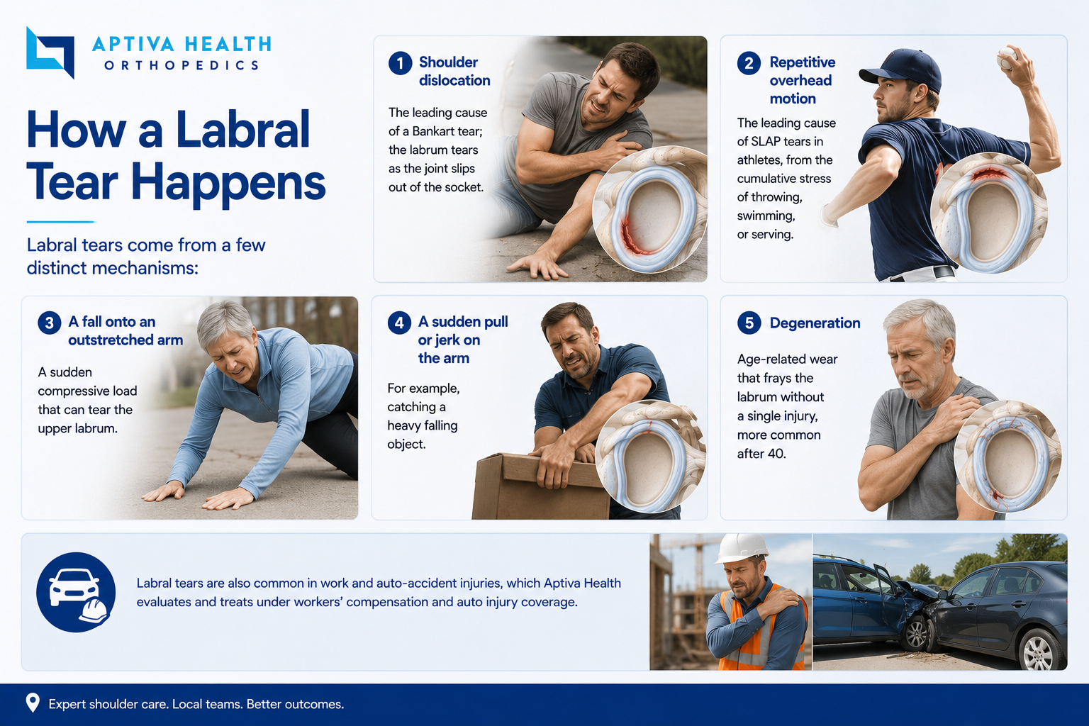 How a labral tear happens — dislocation and overhead injuries