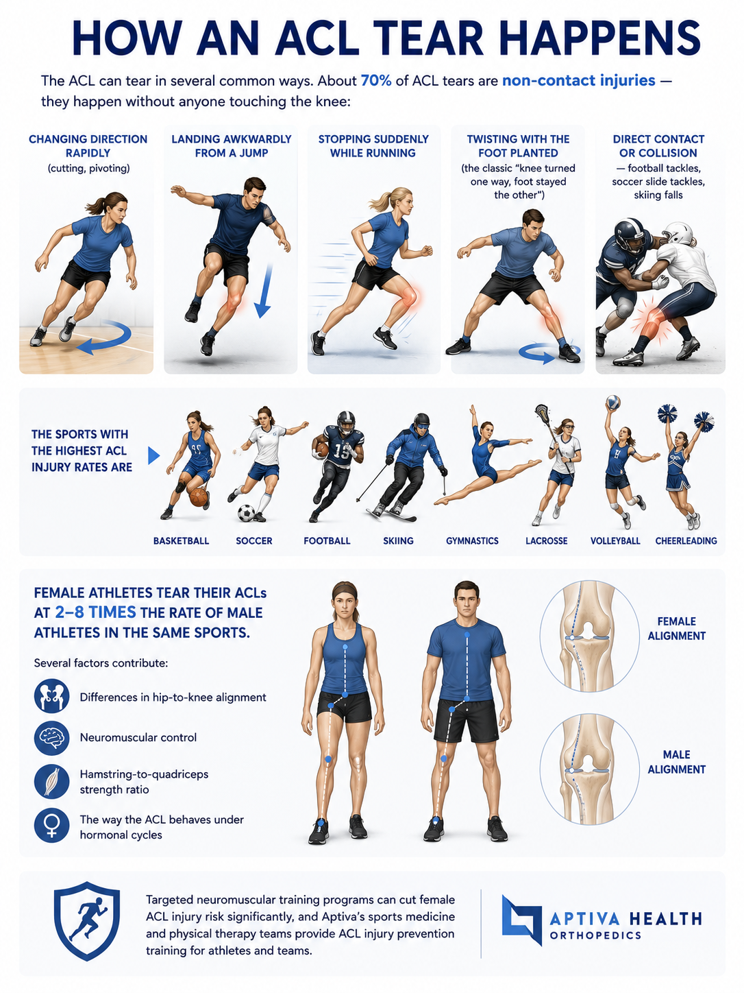 How does an ACL tear happen?