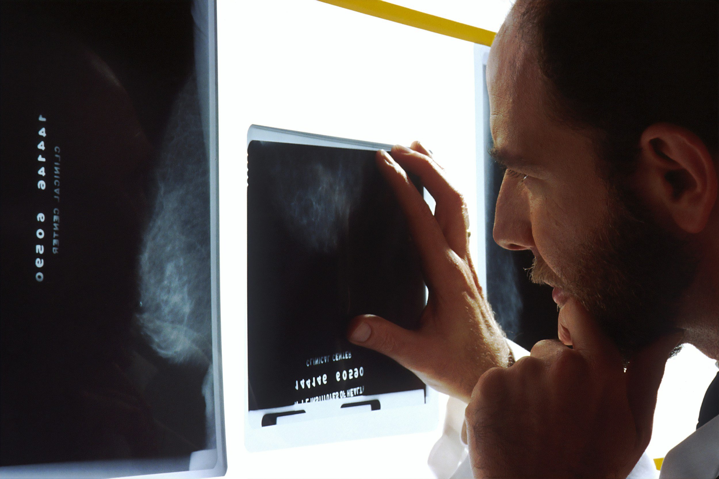 Prostate Cancer Treatment Options