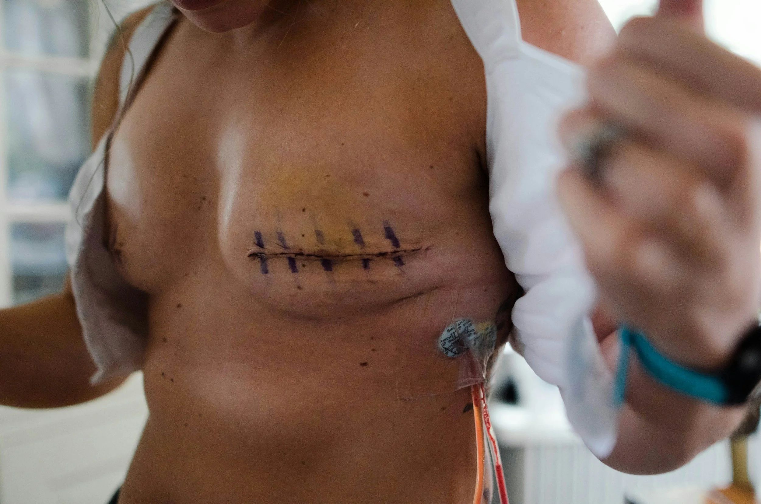 Breast Cancer Treatment