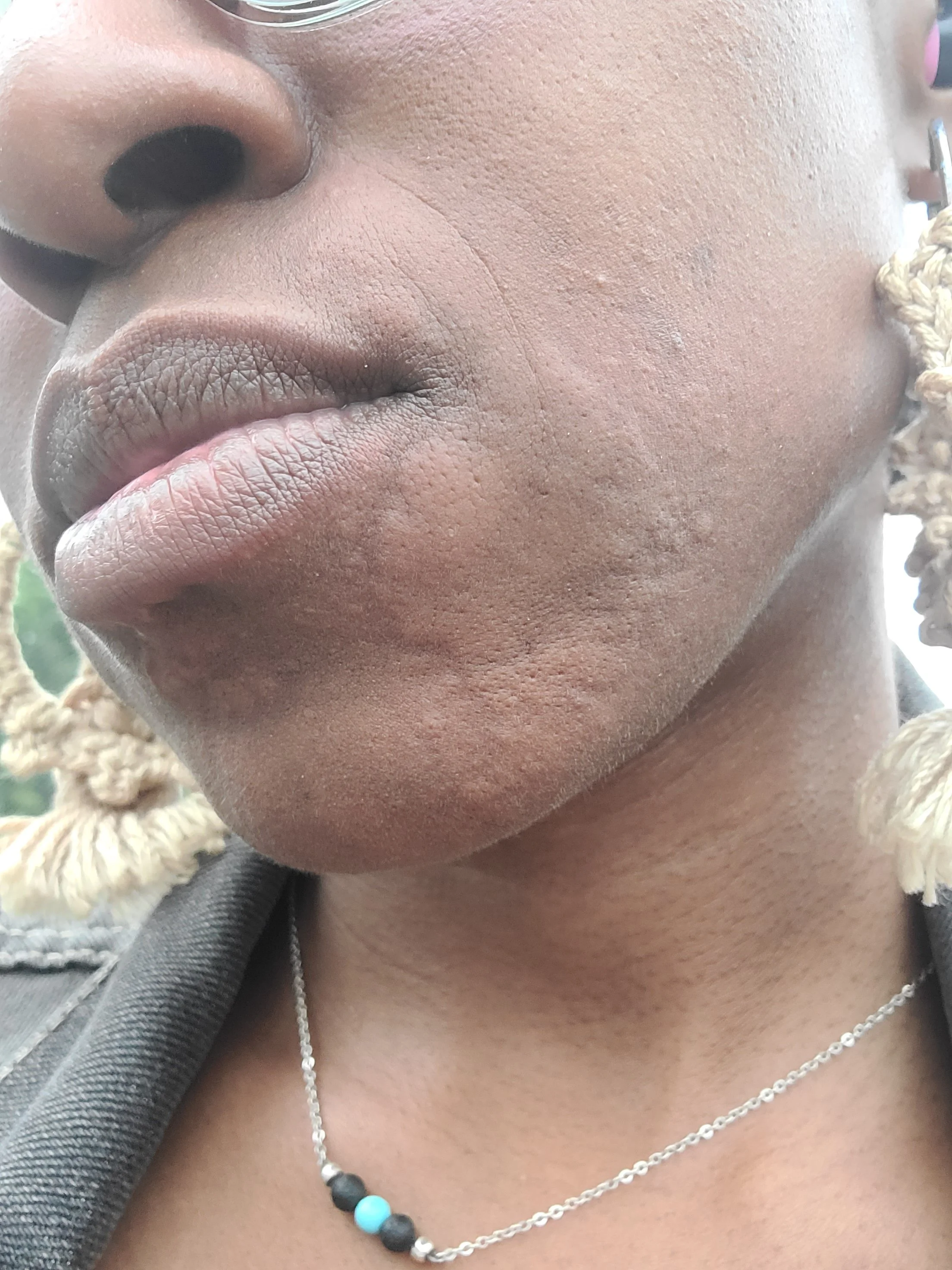 Hives on my face