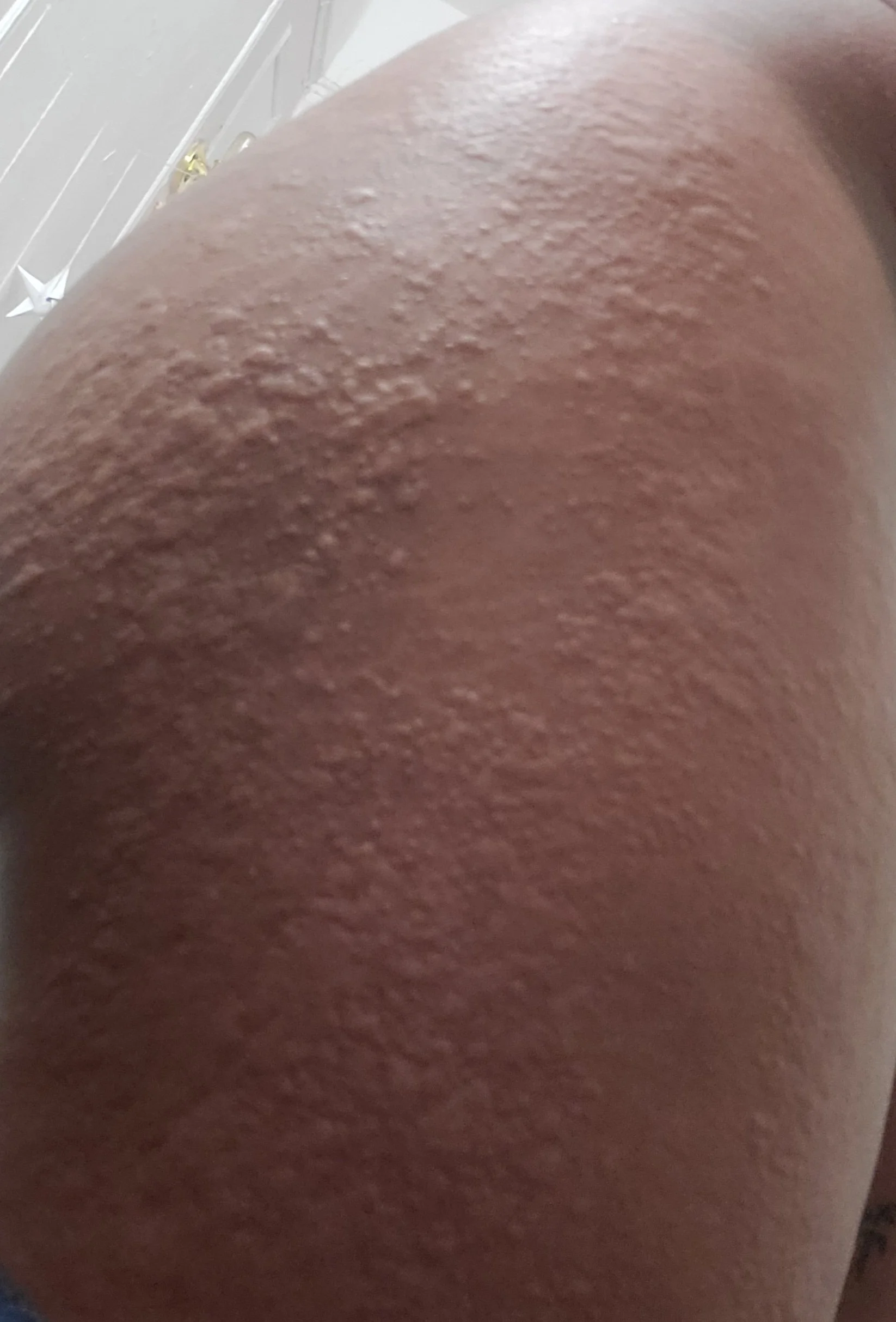 Hives on my glutes &amp; thighs