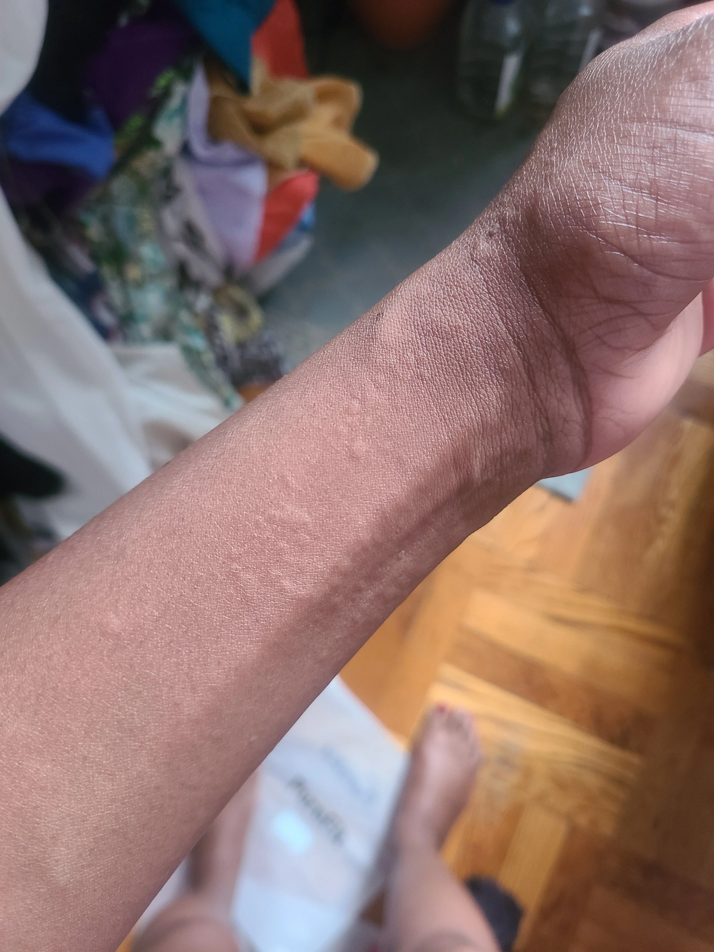 Hives on my wrist