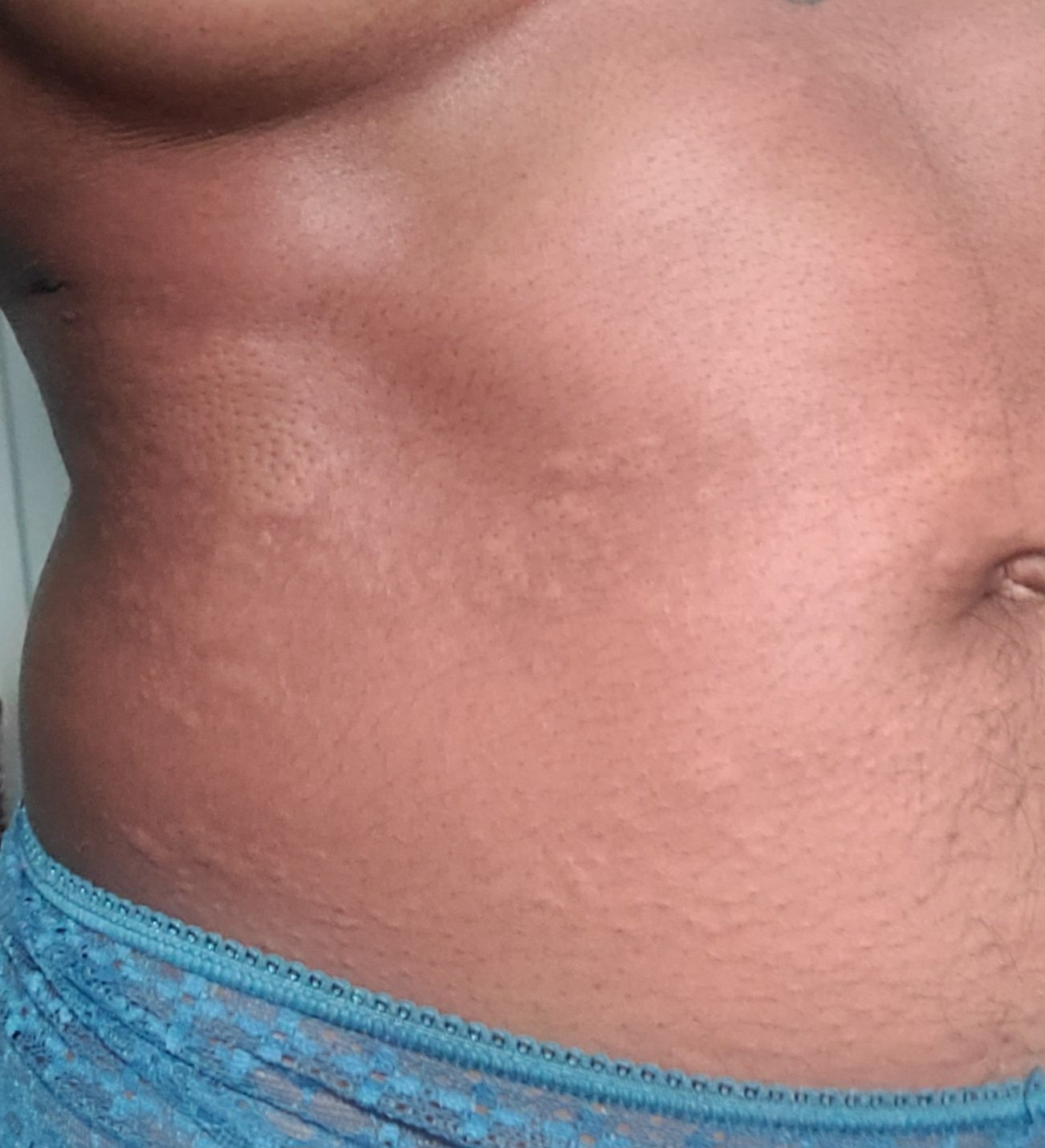 Hives on my torso