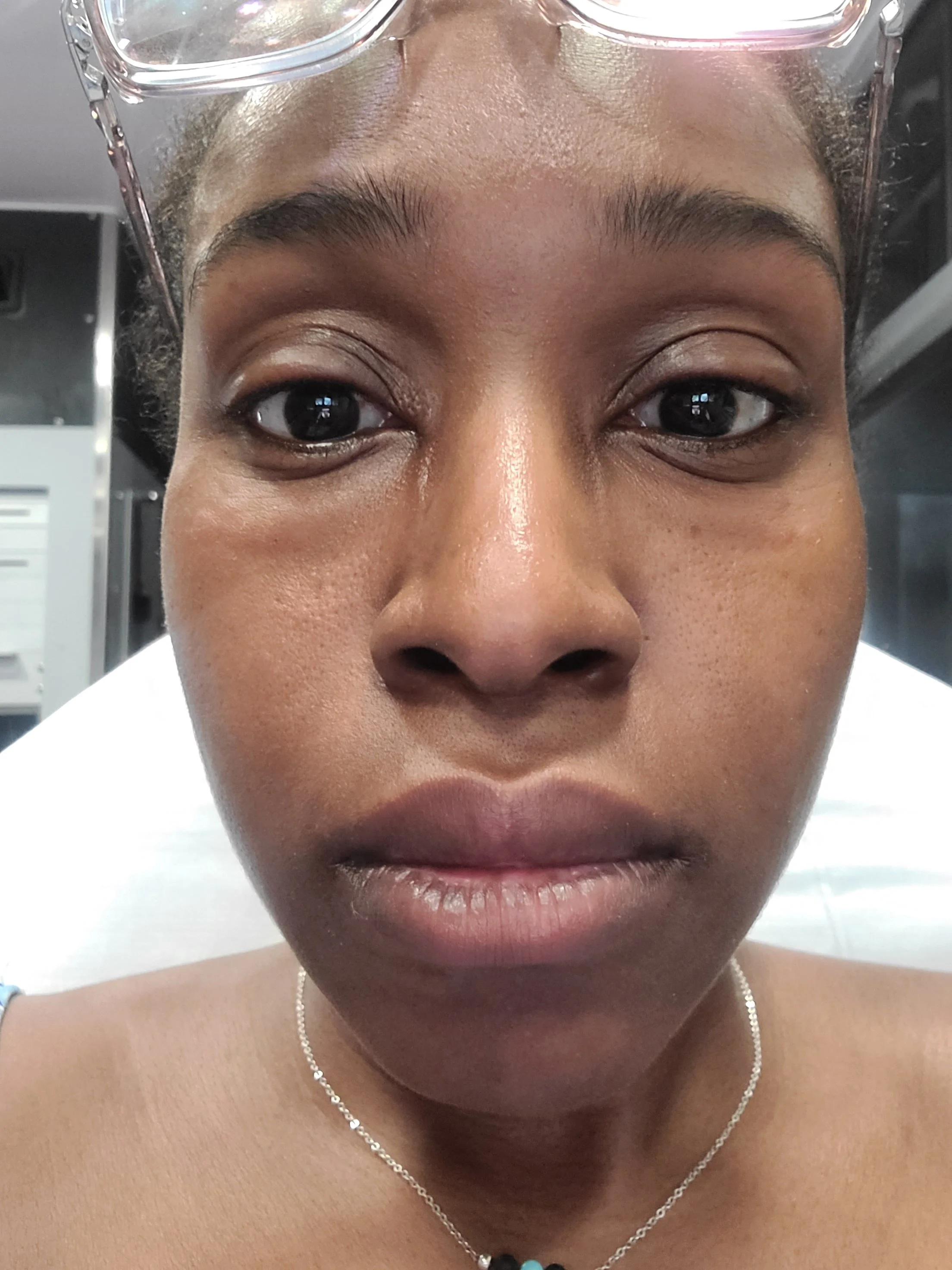 Anaphylaxis - an eye opener