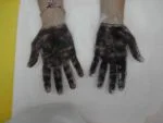 Handflächen im Minorschen Schweißtest vor Behandlung. Schwitzflächen blau-schwarz