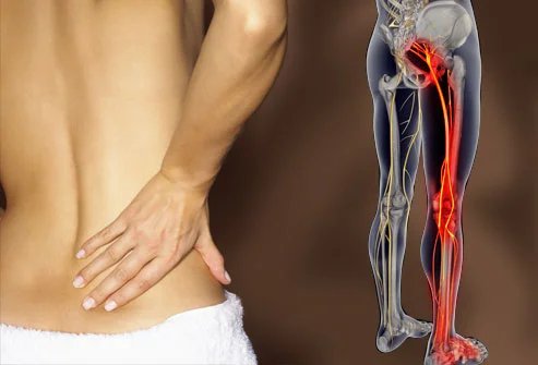 webmd_rm_photo_of_lower_back_pain.jpg