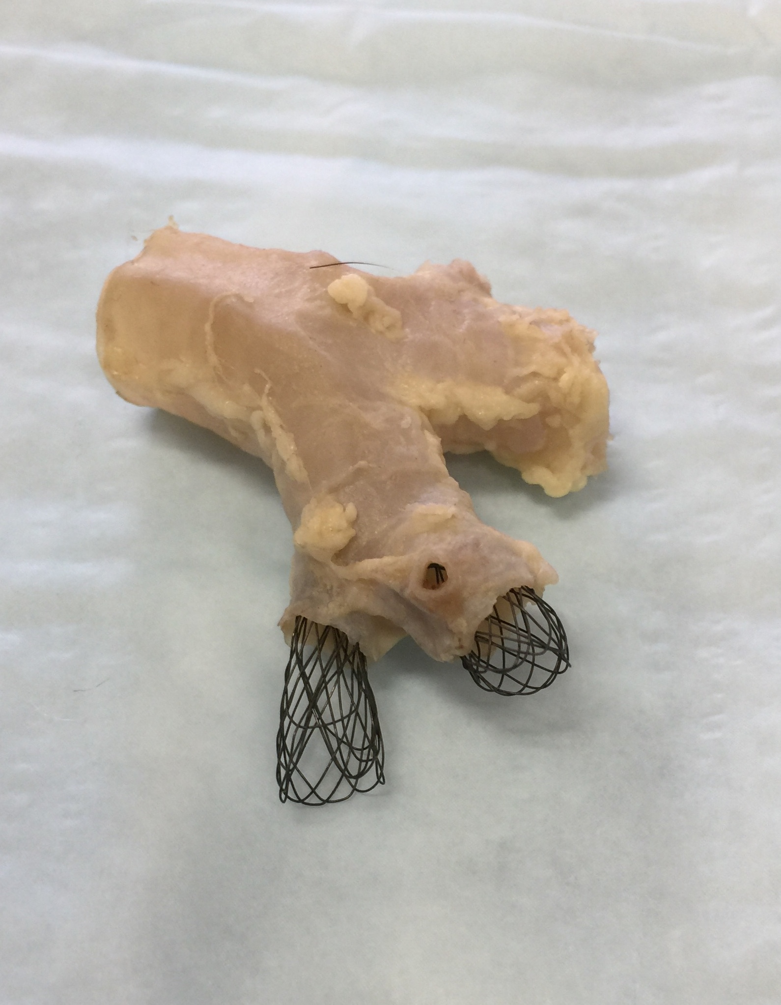 Cadaver Bronchus with BBS