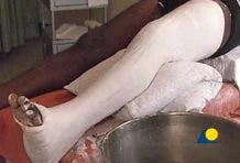 broken-leg-in-plaster