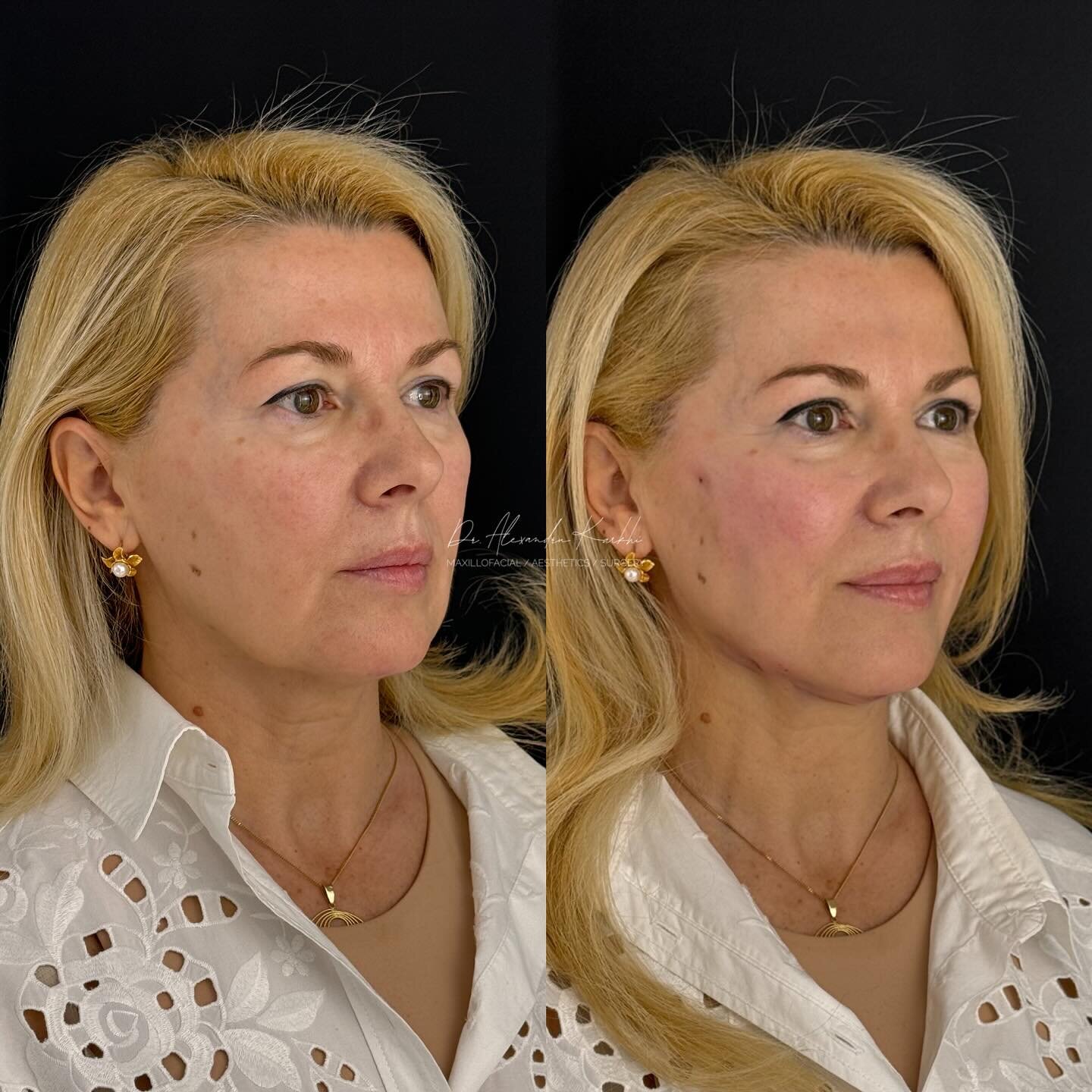 Liftingul feței și al g&acirc;tului cu fire resorbabile DR.K 🪡 
.
Face and neck lifting with DR.K threads 🪡
.
#drk #threads #threadlift #itworks #facelift #nonsurgical #lift