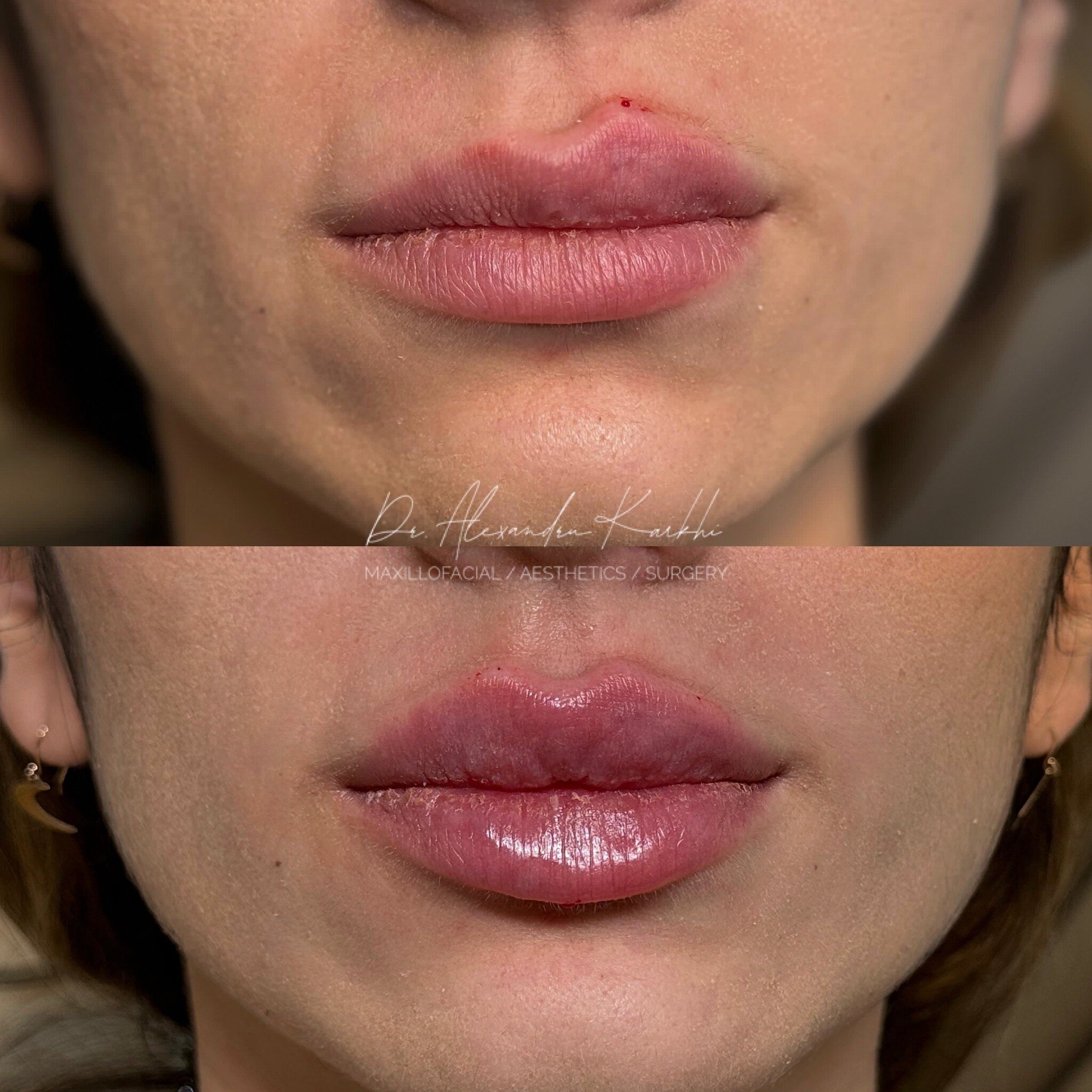 DR.K Lips 💉👄

Exclusively available at CLINICA DR.K Medical Centers ⚜️

😷 Treatment: Non-surgical Lips enhancement
🎯 Purpose: to project and to create the right proportions of the upper and lower Lips
👓 How it works: Non-Surgical augmentation us