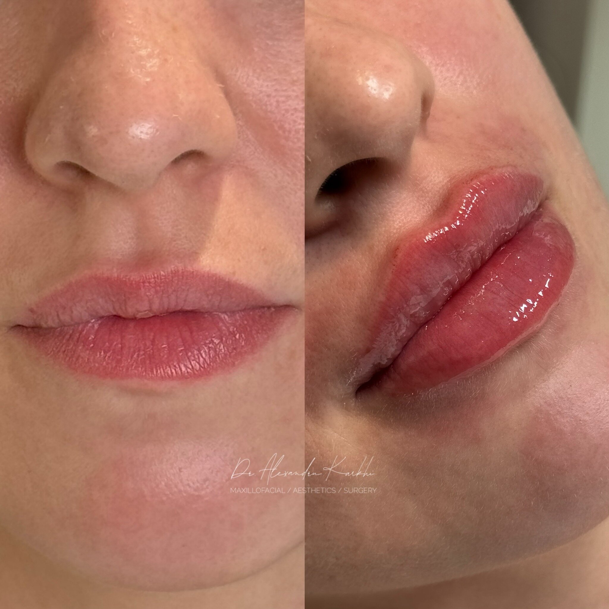 DR.K Lips 💉👄

Exclusively available at CLINICA DR.K Medical Centers ⚜️

😷 Treatment: Non-surgical Lips enhancement
🎯 Purpose: to project and to create the right proportions of the upper and lower Lips
👓 How it works: Non-Surgical augmentation us