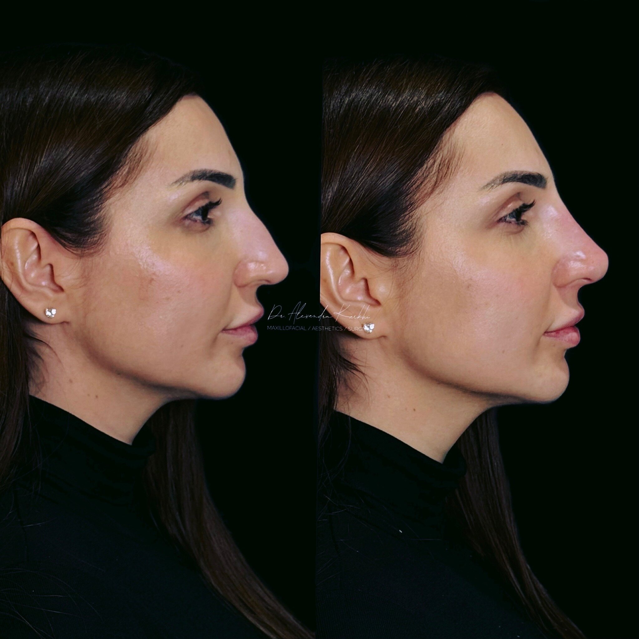 DR.K&rsquo;s Nose reshaping with dermal fillers is created for patients who need minor nasal remodeling but are not looking for a surgical rhinoplasty
.
Exclusively available at DR.K 👨🏼&zwj;⚕️
.
🎯 Treatment: Medical rhinocorrection based on long l