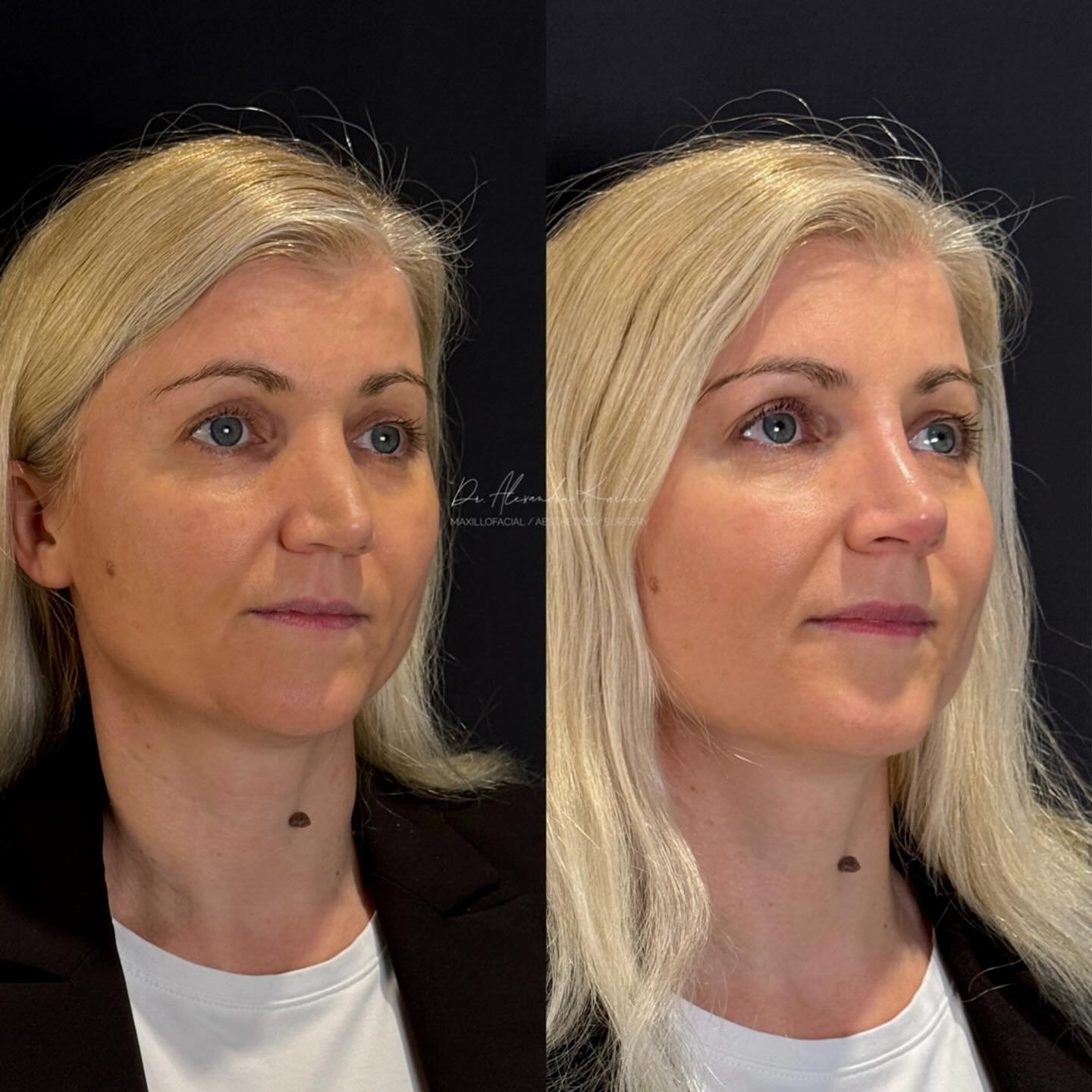 DR.K&rsquo;s Nose reshaping with dermal fillers is created for patients who need minor nasal remodeling but are not looking for a surgical rhinoplasty
.
Exclusively available at DR.K 👨🏼&zwj;⚕️
.
🎯 Treatment: Medical rhinocorrection based on long l