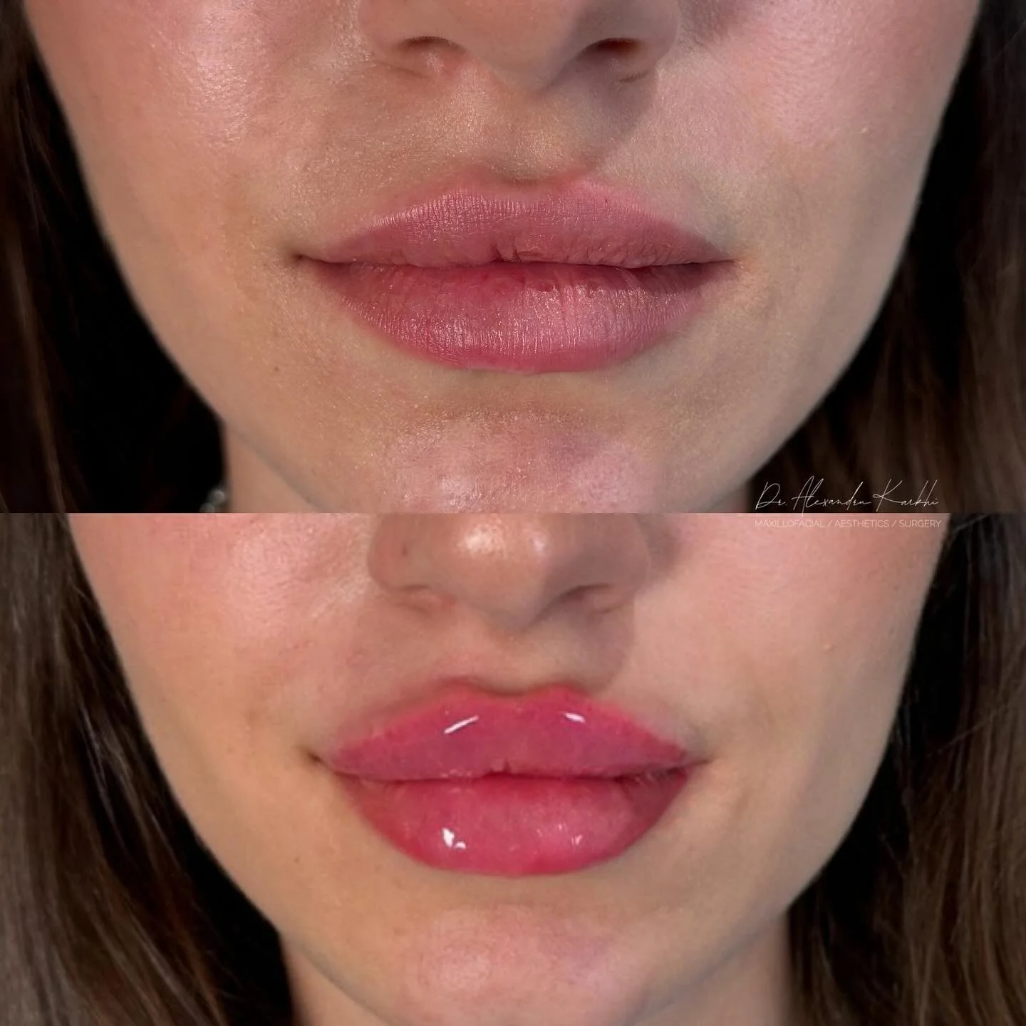DR.K Lips 💉👄

Exclusively available at CLINICA DR.K Medical Centers ⚜️

😷 Treatment: Non-surgical Lips enhancement
🎯 Purpose: to project and to create the right proportions of the upper and lower Lips
👓 How it works: Non-Surgical augmentation us