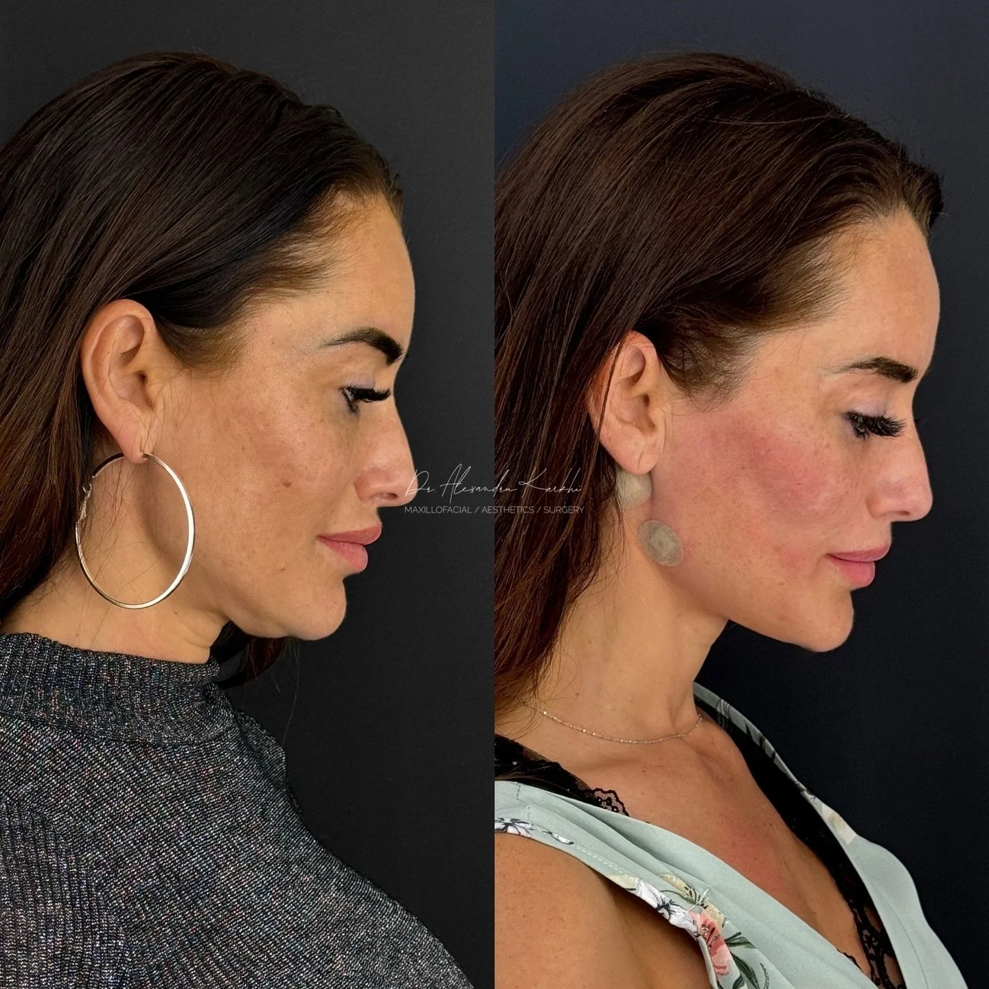 DR.K facial contouring and neck tightening 💫
.
#drk #face #neck #contouring #doublechin