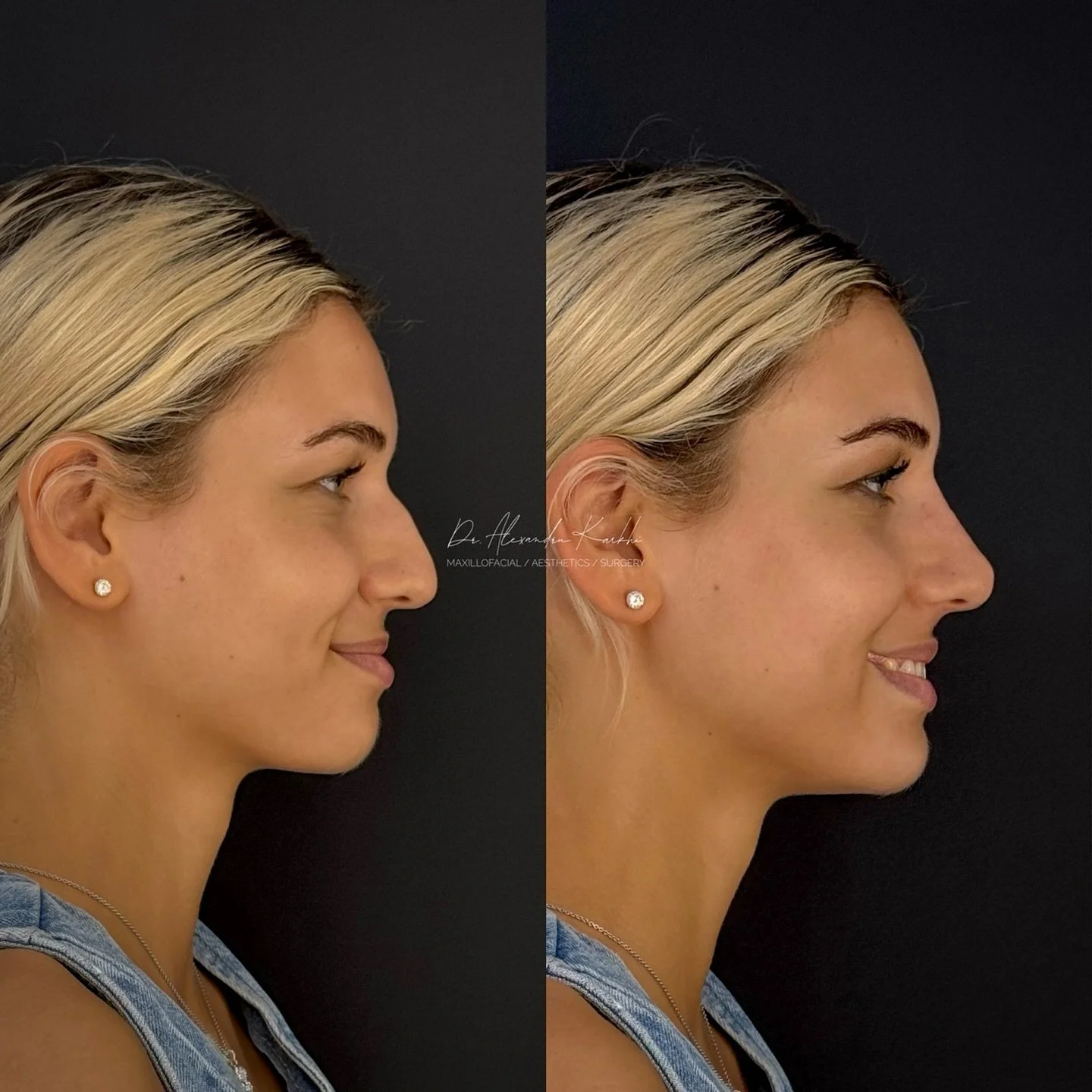 DR.K&rsquo;s Nose reshaping with dermal fillers is created for patients who need minor nasal remodeling but are not looking for a surgical rhinoplasty
.
Exclusively available at DR.K 👨🏼&zwj;⚕️
.
🎯 Treatment: Medical rhinocorrection based on long l