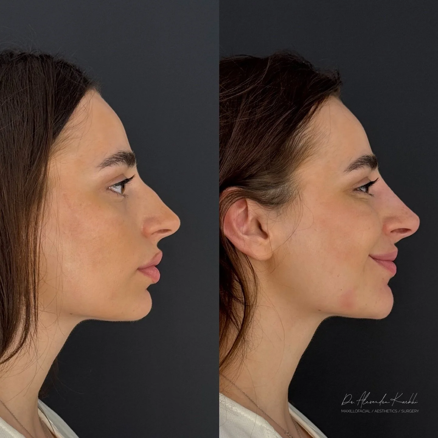 DR.K&rsquo;s Nose reshaping with dermal fillers is created for patients who need minor nasal remodeling but are not looking for a surgical rhinoplasty
.
Exclusively available at DR.K 👨🏼&zwj;⚕️
.
🎯 Treatment: Medical rhinocorrection based on long l